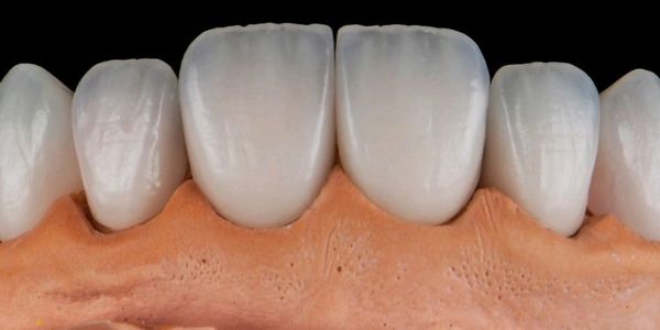 Implant retained dental crown and bridge