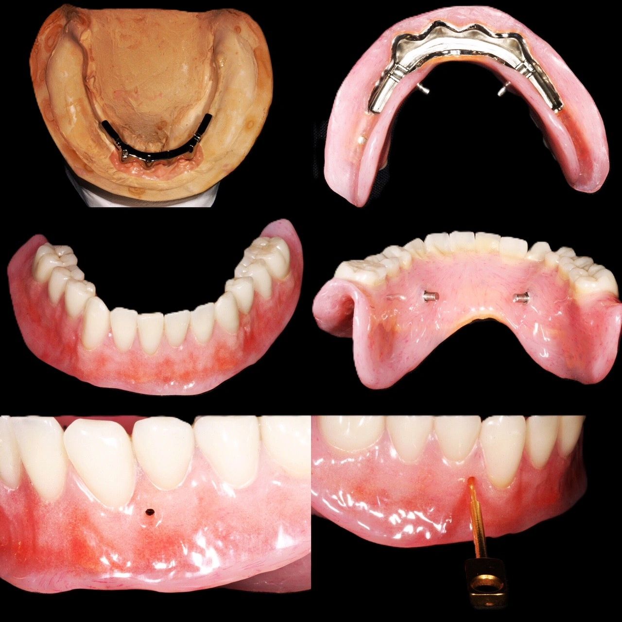 Removable dental prosthesis and dentures